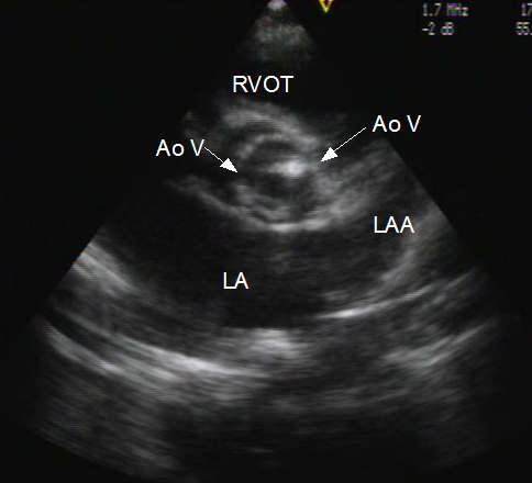 Aortic stenosis in short axis view - valve open