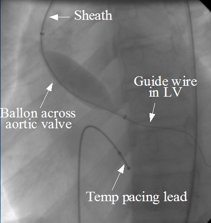 Balloon aortic valvotomy (BAV)