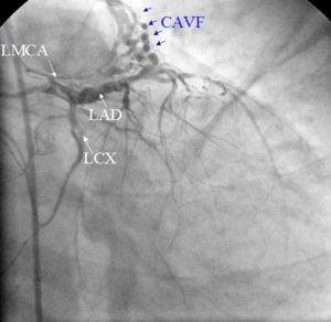 cavf-from-lad-rao-caudal-view – All About Cardiovascular System and ...