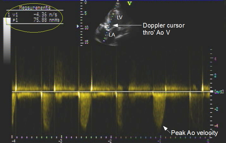 Continuous wave (CW) Doppler imaging in aortic stenosis
