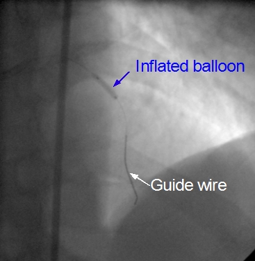 Inflated balloon and guide wire in LAD