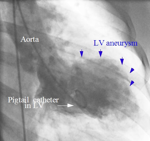 Left ventricular aneurysm seen on left ventriculogram
