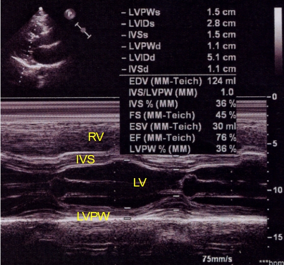 M-Mode Echocardiography and 2D Cardiac Measurements*