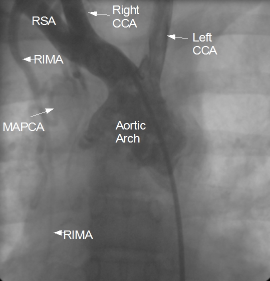 MAPCA from right internal mammary artery 1