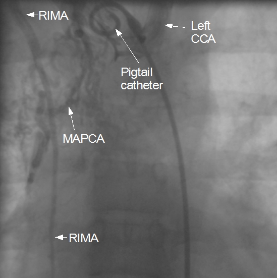 Major aortopulmonary collateral from RIMA 2