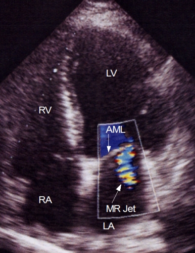 Mitral regurgitation jet by color Doppler echo from apical four chamber view