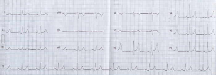 normal t wave size