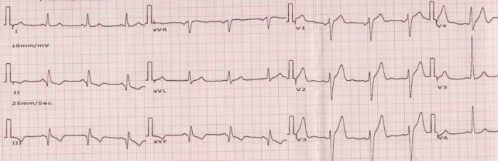 ECG Quiz 9