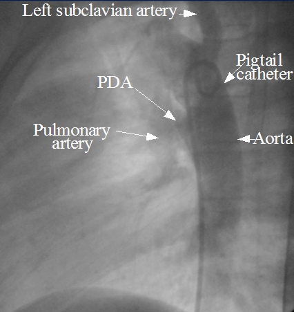 Device closure of patent ductus arteriosus (PDA) – All About ...