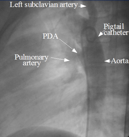 PDA angio prior to device closure