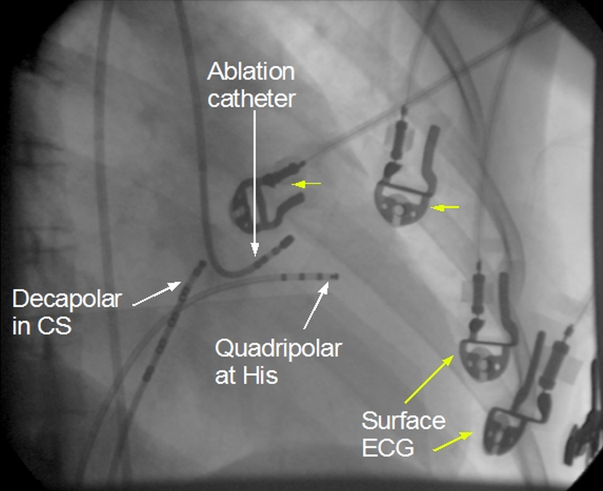 Ablation of atrioventricular reentrant tachycardia (AVRT)