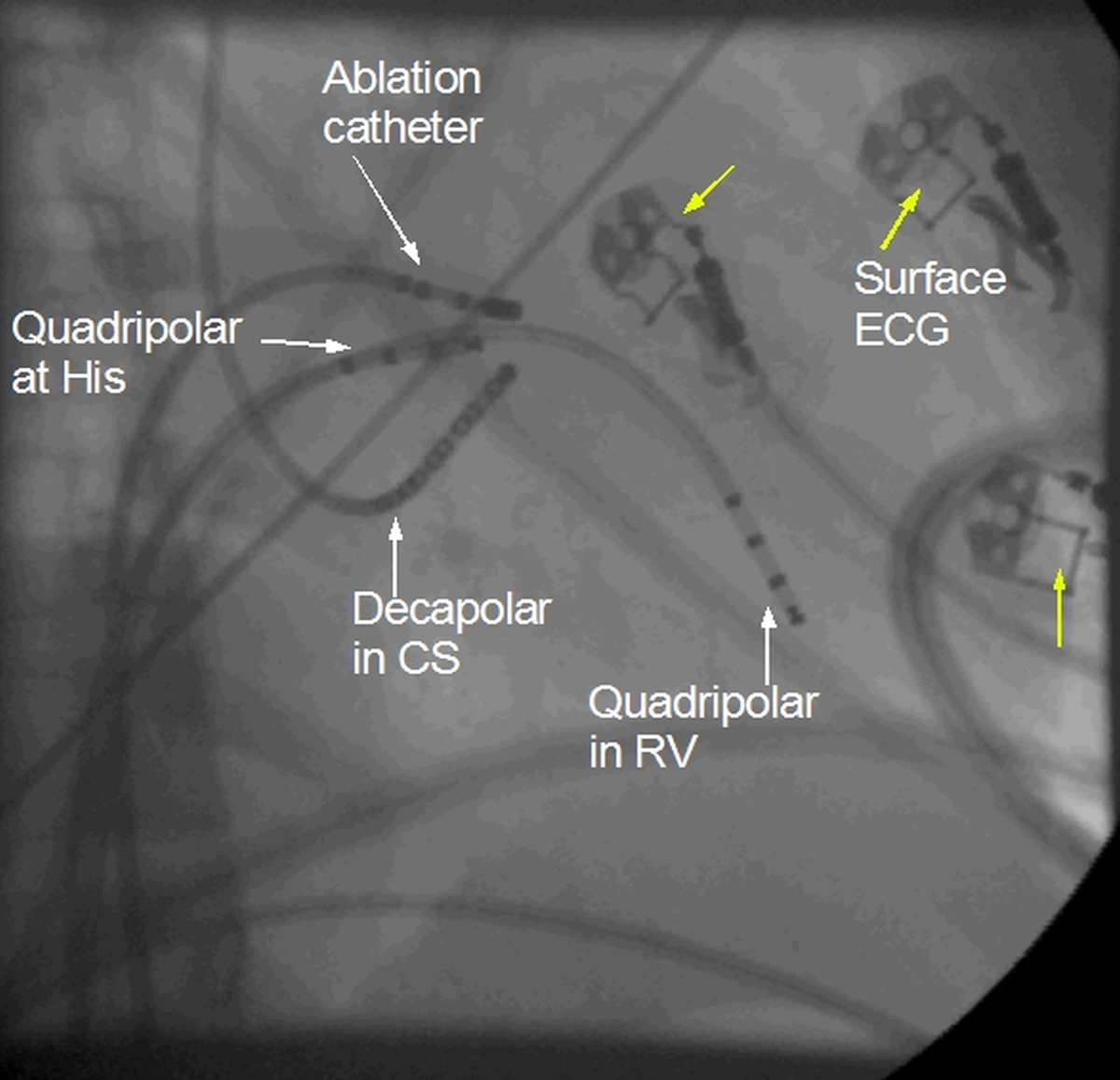 EP catheters in RAO view