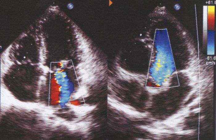 Apical four chamber and five chamber view in echocardiography