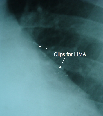 Clips occluding branches of left internal mammary artery