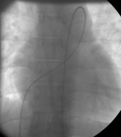 Closed loop catheter position in PDA