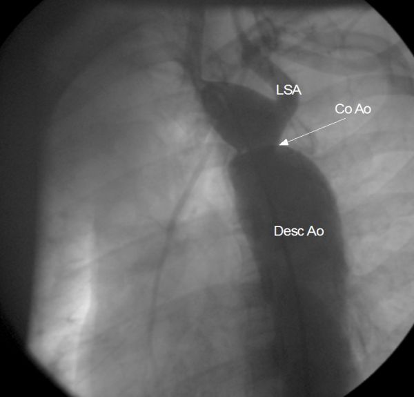 Coarctation of aorta in LAO view