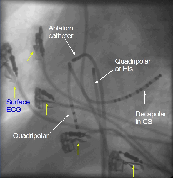 EP catheters in LAO view