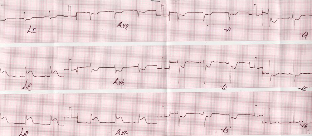 Inferior wall myocardial infarction