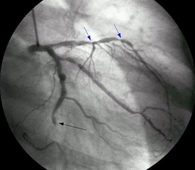 Total occlusion of left circumflex coronary artery and lesions in left anterior descending coronary artery