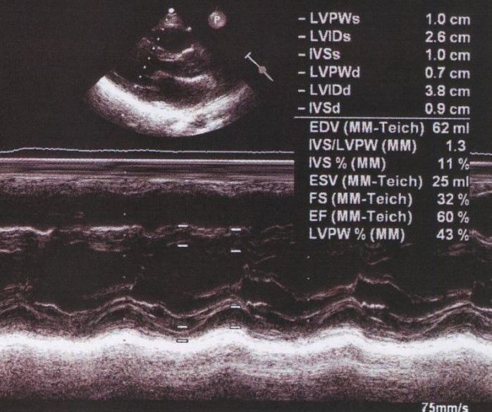 Left ventricular measurements in M - Mode echocardiography