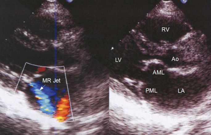 Echocardiogram in mitral stenosis and regurgitation