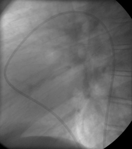 PDA catheter position in lateral view