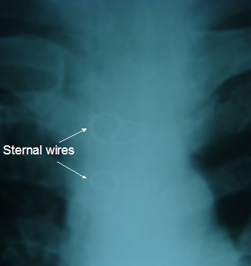 Magnified view of sternal wires on chest X ray after CABG