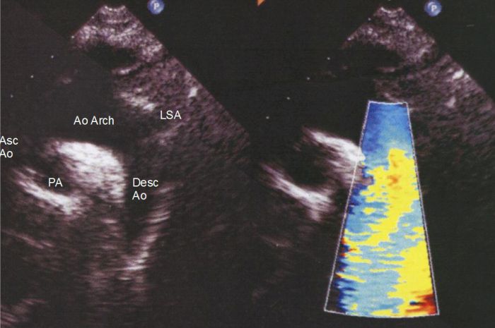 Supra sternal view in echocardiography