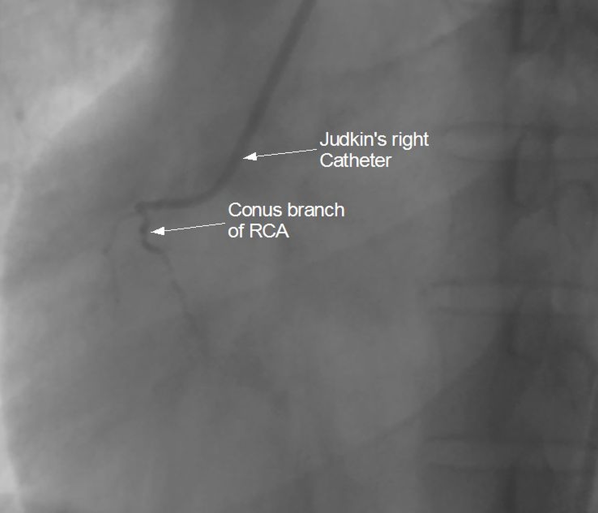 Catheter slipping into conus branch during right coronary angiography