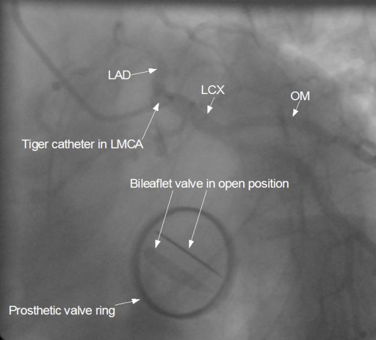 Left coronary angiogram by transradial route in post MVR case