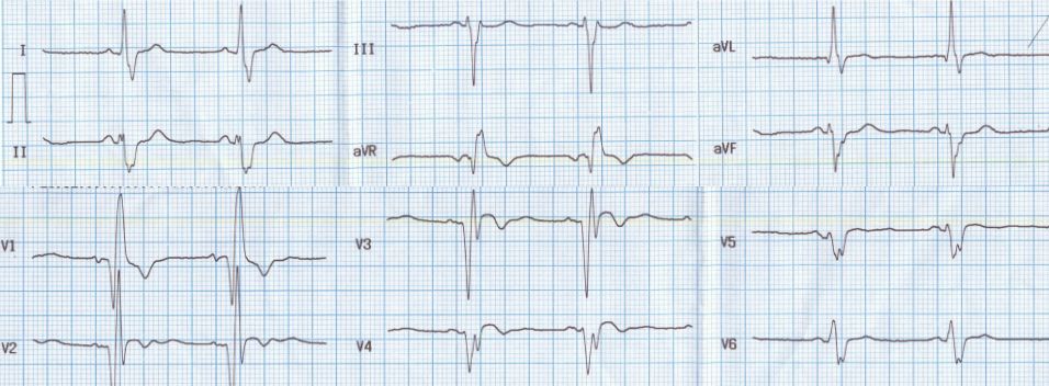 Old anterior wall myocardial infarction, RBBB, LAHB