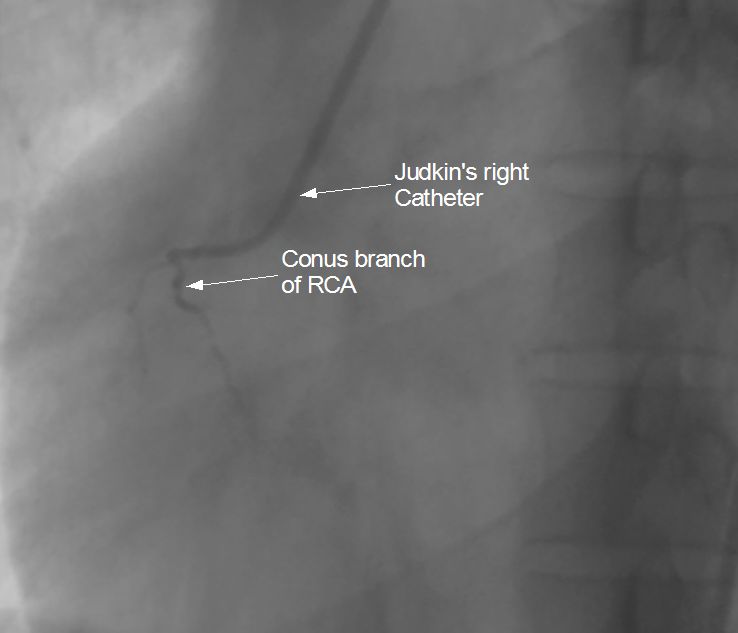 Catheter slipping into conus branch