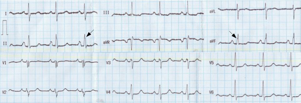 Crochetage sign • LITFL • ECG Library Diagnosis