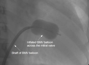 Fully dilated BMV balloon across mitral valve