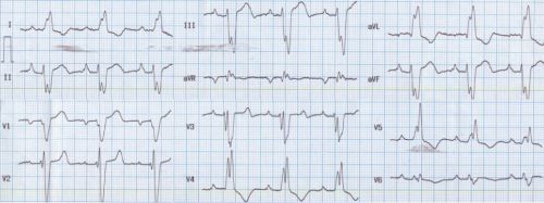 Left bundle branch block with left axis deviation and MI