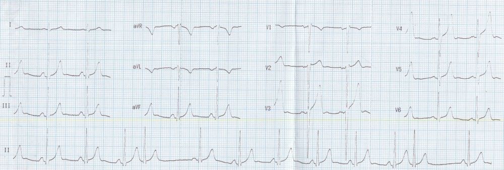 Supraventricular ectopics – All About Cardiovascular System and Disorders