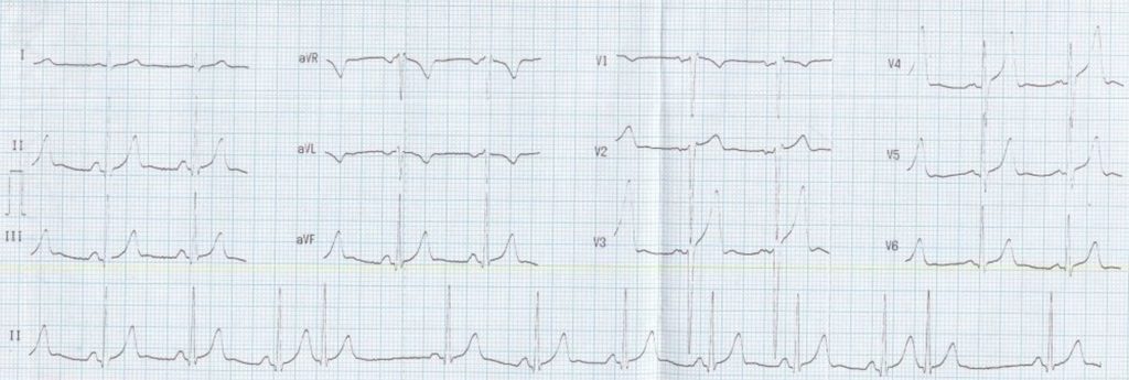 Supraventricular ectopic beats