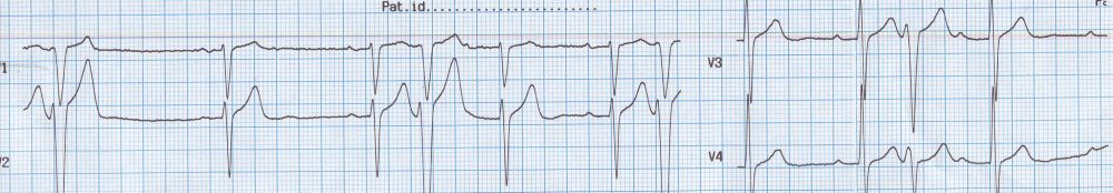 VPC with concealed retrograde conduction