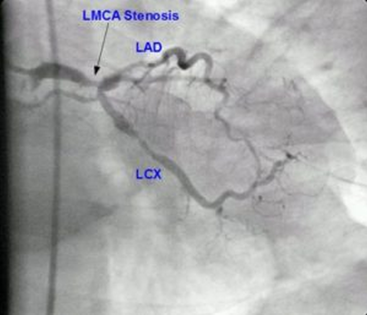Left main coronary artery stenosis