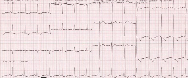 Severe LVH with strain pattern in severe aortic stenosis – All About ...