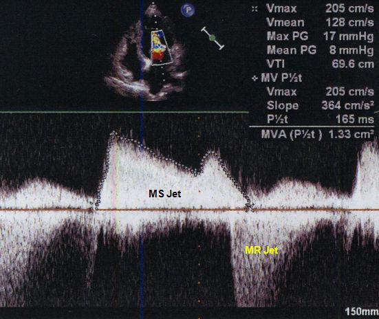 Mitral Doppler tracing in MS/MR