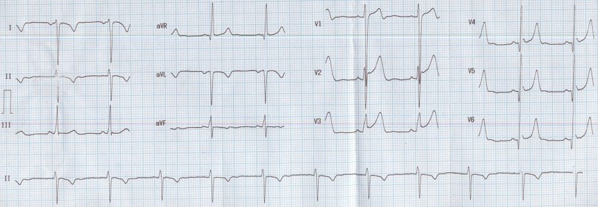 Arm Lead Inversion Technical Dextrocardia