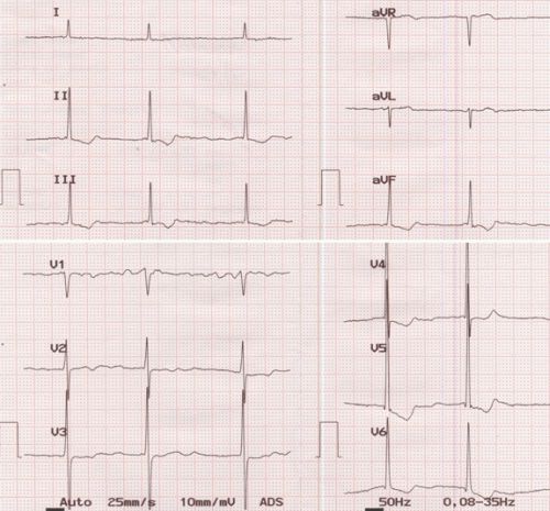 Atrial fibrillation with slow ventricular rate and left ventricular hypertrophy
