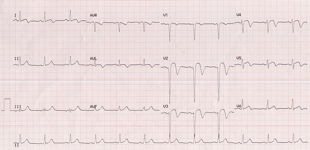 Pardee sign on ECG in acute myocardial infarction