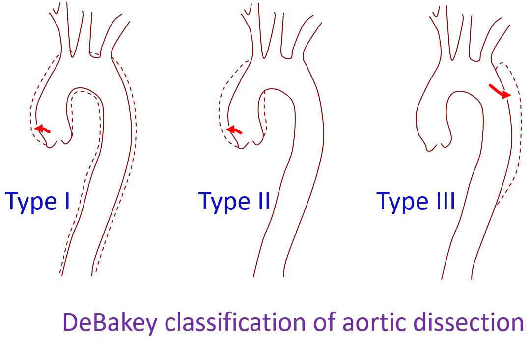 DeBakey classification of aortic dissection