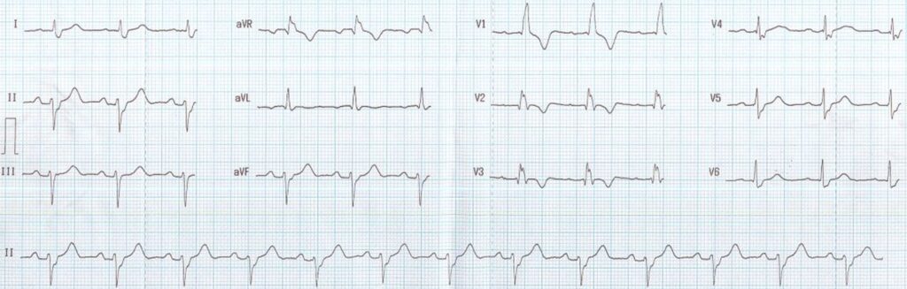 right bundle branch block with left anterior hemiblock icd 10