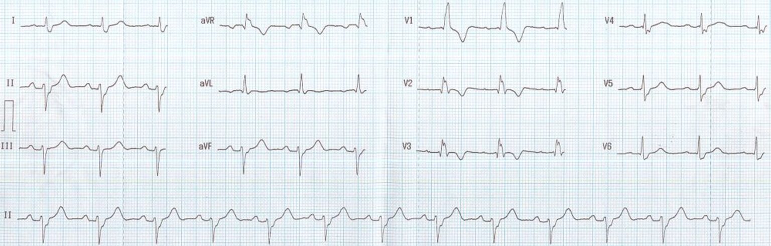 Right Bundle Branch Block with Left Anterior Hemiblock – All About ...