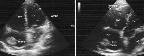 Right atrial thrombus in right ventricular EMF