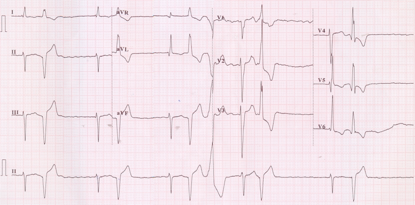 Atrial fibrillation with slow ventricular rate, ventricular bigeminy, bidirectional ventricular ectopy