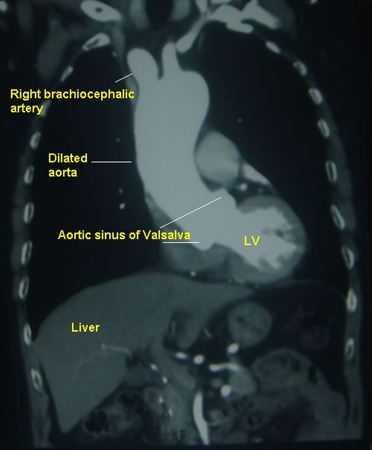 Dilated aorta on contrast enhanced CT scan